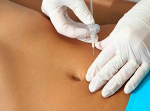 Carboxiterapia Guayaquil – Thai Beauty Center Spa
